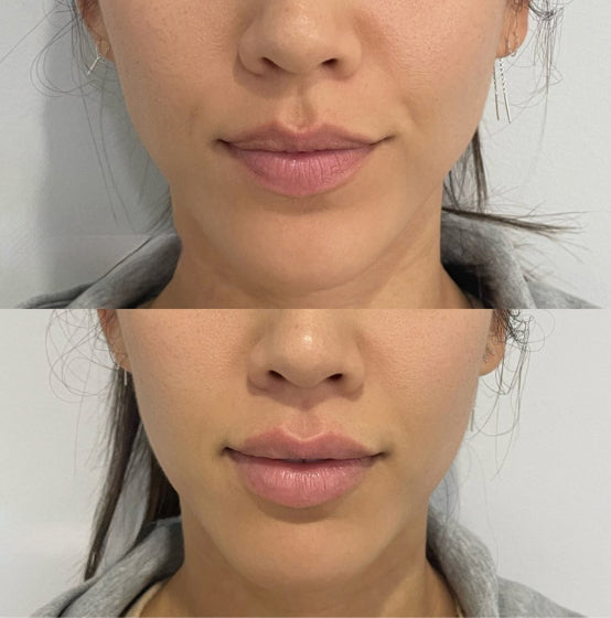 lips_before_and_after_4_b98435ca-ae0b-41c1-9bb6-42df4e064465.jpg